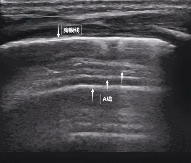 图为正常新生儿肺部超声表现