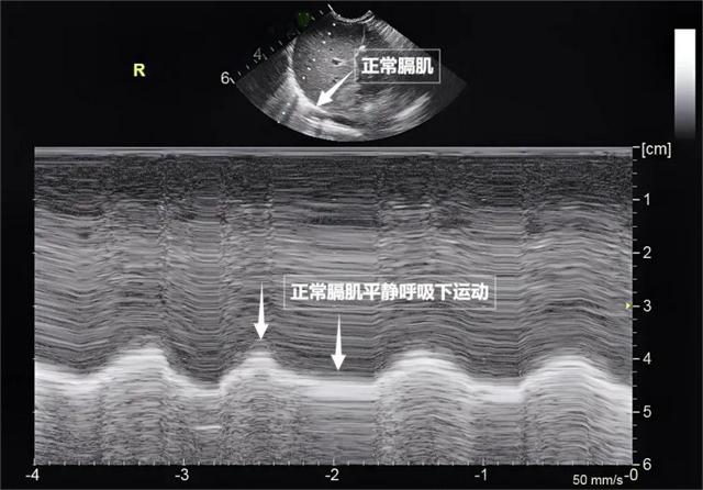 图为正常膈肌超声表现