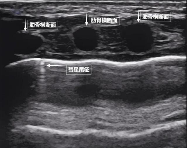 图为正常新生儿肺部超声表现