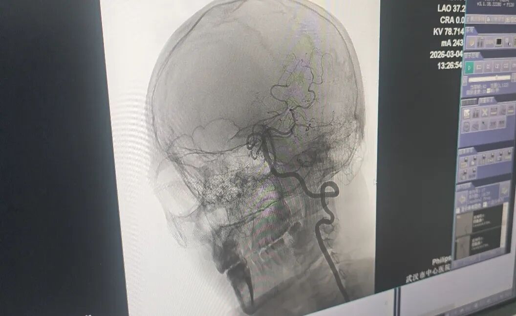 医生精准打通王先生堵塞的血管。记者李慧紫 摄