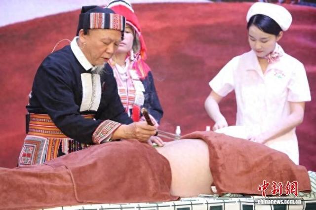 卢韶羲在展示瑶医水蜡烛灸法。(广东省中医院 供图)